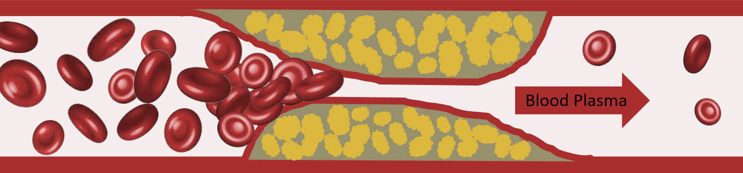Blocked blood vessel